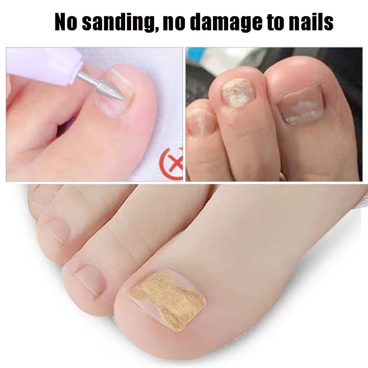 10 Stück klebstofffreie orthopädische Zehennagel-Einlagen zur Korrektur von Nagelrillen, transparente Unterseite, weiße Unterseite, blaue Unterseite
