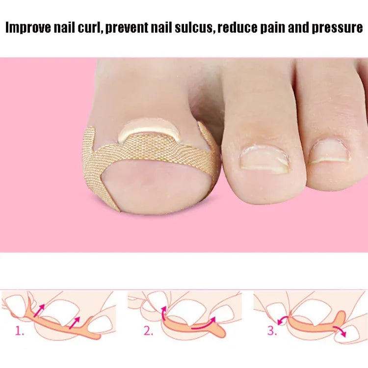 10 Sets gerolltes Nagelkorrekturband Zehennagelrillenband