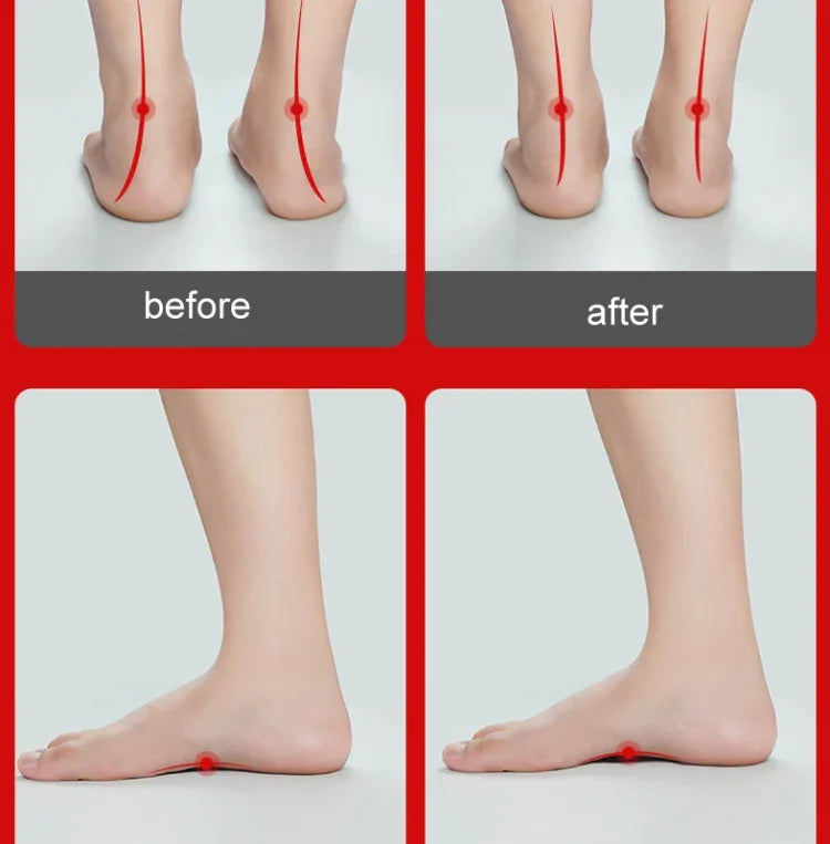 Plattfuß Orthopädische Einlegesohle Fußgewölbeunterstützung Pad Erwachsene Und Kind Fuß Valgus Orthese, L (Weiß)