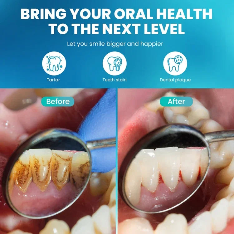 Ultraschall-Zahnsteinentferner Elektrischer Zahnpflegereiniger für zu Hause